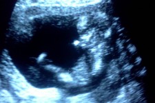 Baby scan #1 - He's already wearing his crash helmet! Baby scan #1 - He's already wearing his crash helmet!
